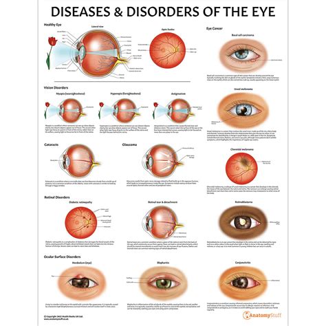 list of degenerative eye diseases.
